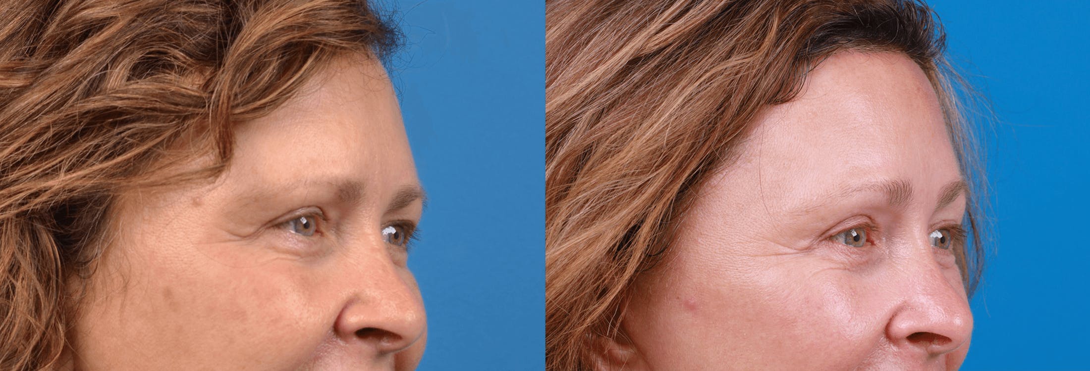 Brow Lift Before & After Gallery - Patient 122405637 - Image 3