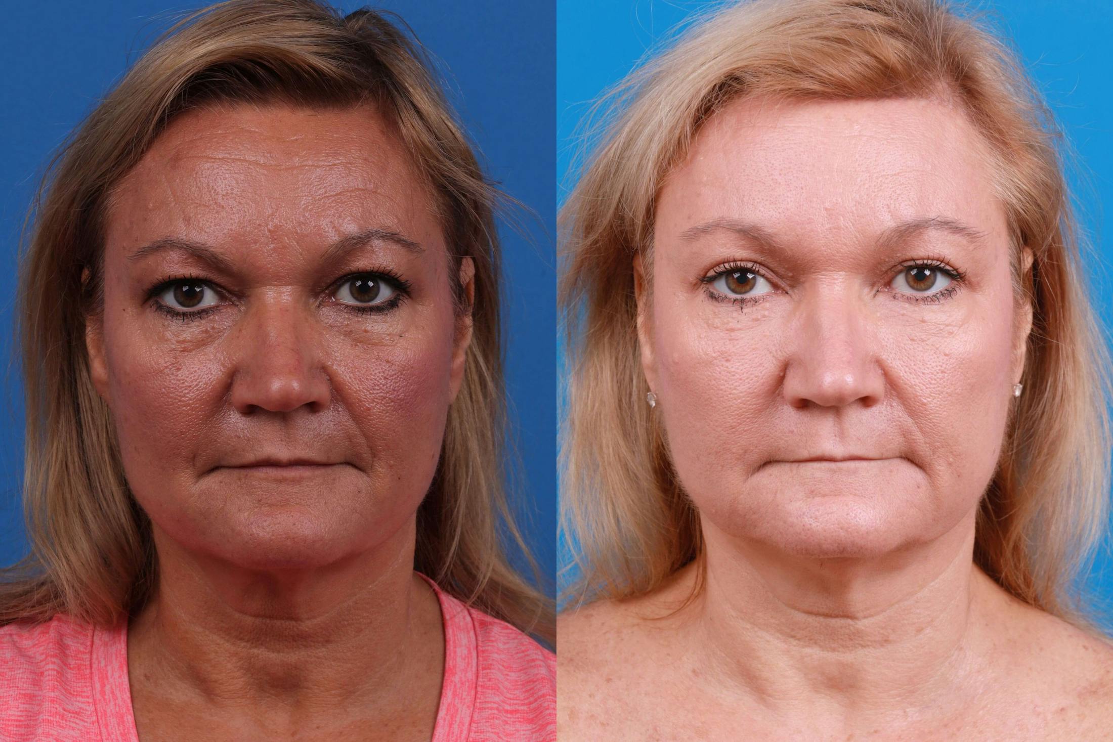 Brow Lift Before & After Gallery - Patient 122405639 - Image 1