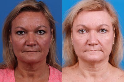 Brow Lift Before & After Gallery - Patient 122405639 - Image 1