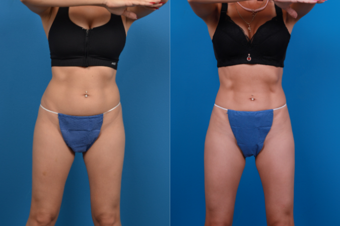 CoolSculpting Before & After Gallery - Patient 139703 - Image 1