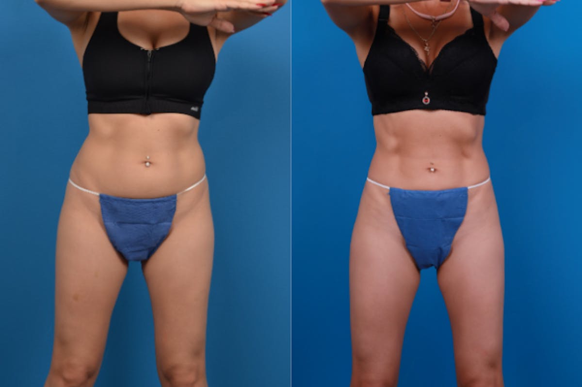 CoolSculpting Before & After Gallery - Patient 122405640 - Image 1
