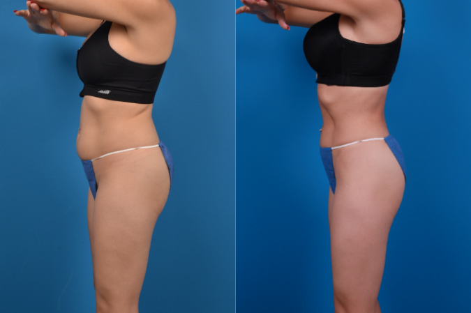 CoolSculpting Before & After Gallery - Patient 139703 - Image 2