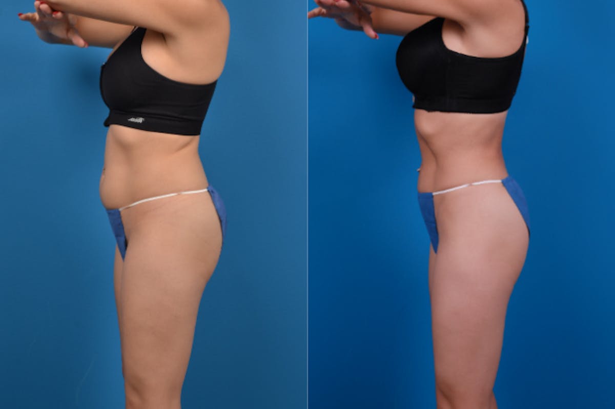 CoolSculpting Before & After Gallery - Patient 122405640 - Image 2