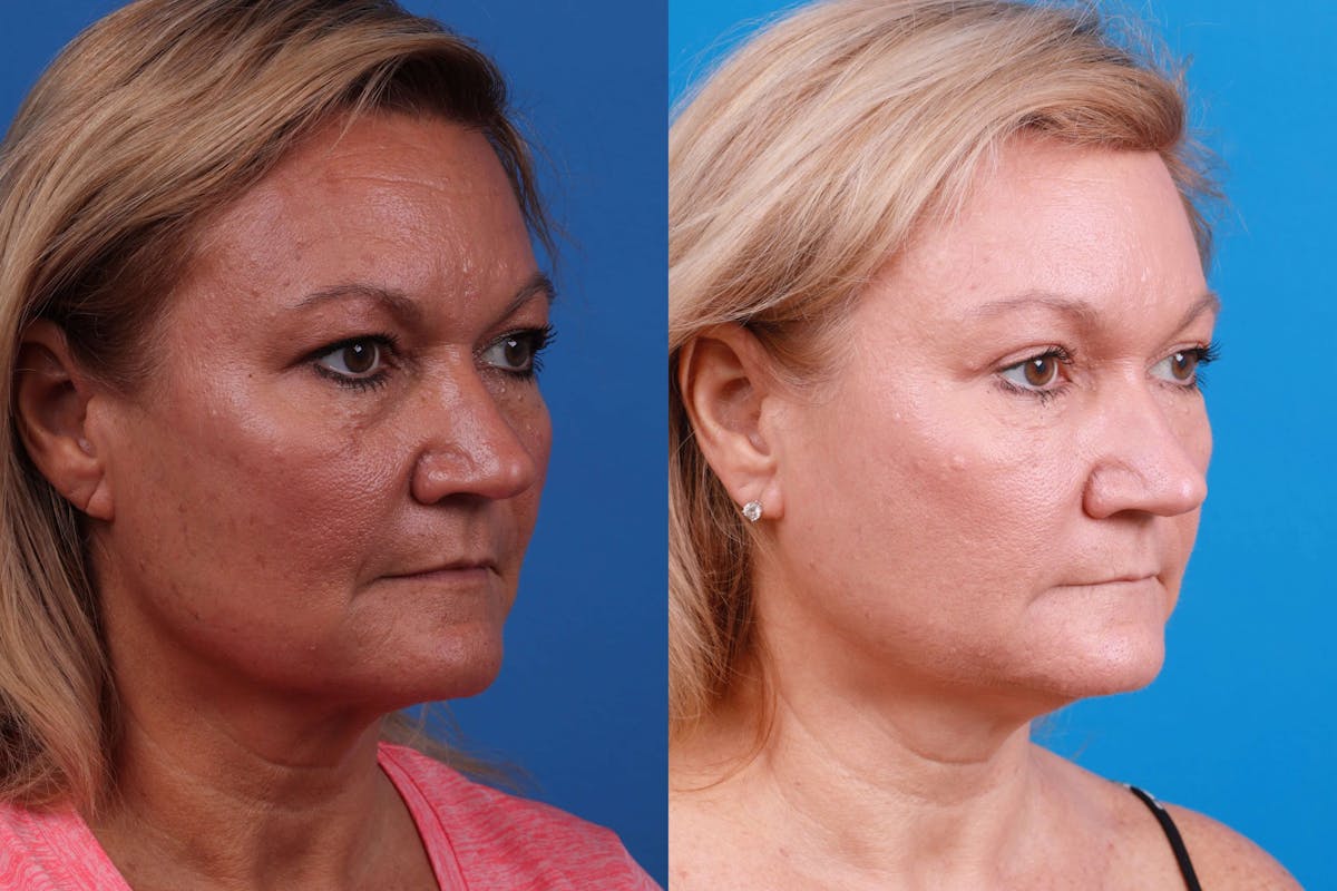 Brow Lift Before & After Gallery - Patient 122405639 - Image 2