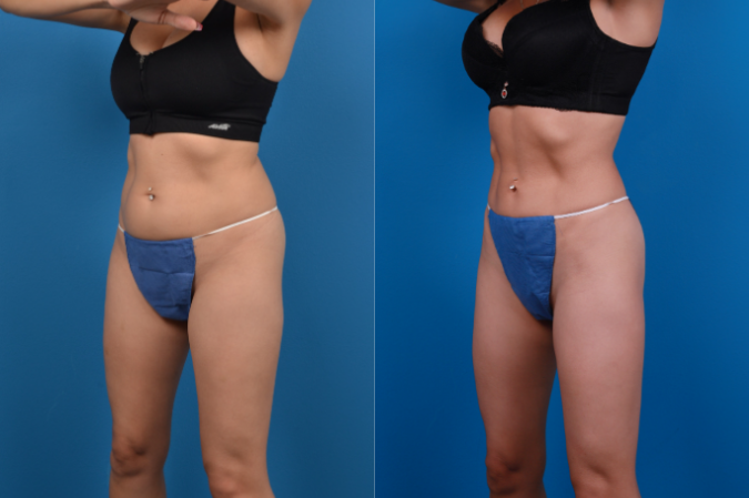 CoolSculpting Before & After Gallery - Patient 139703 - Image 3