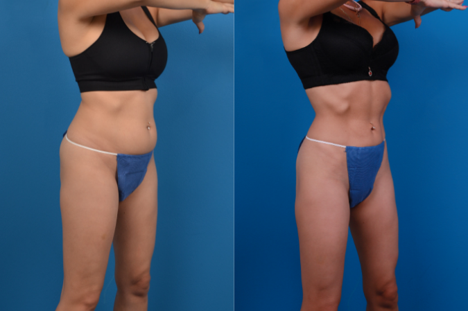 CoolSculpting Before & After Gallery - Patient 139703 - Image 4