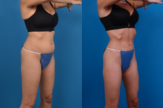 CoolSculpting Before & After Gallery - Patient 122405640 - Image 4