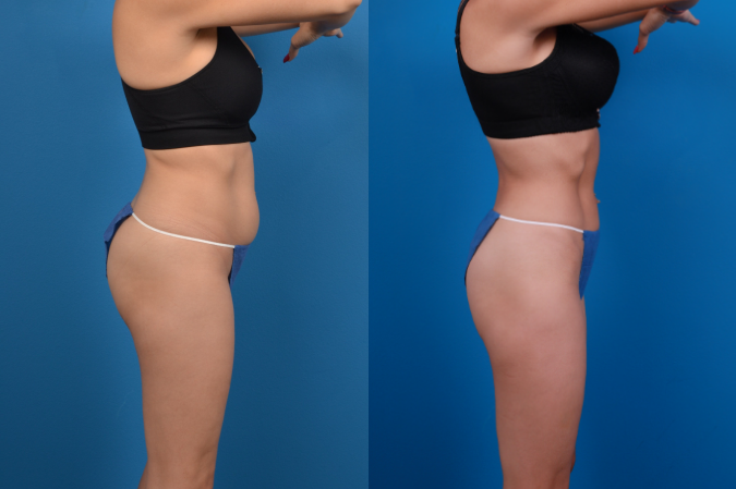 CoolSculpting Before & After Gallery - Patient 139703 - Image 5