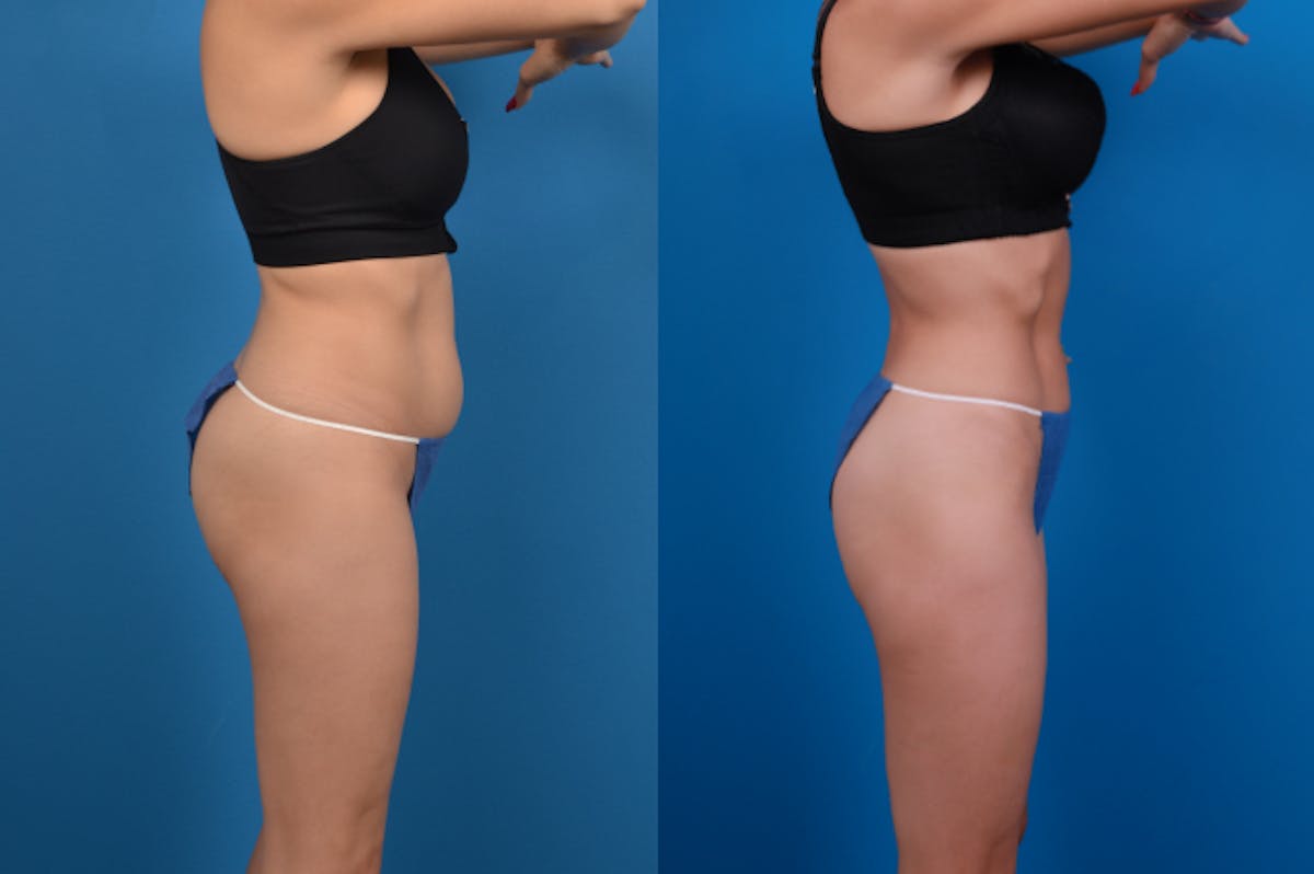 CoolSculpting Before & After Gallery - Patient 122405640 - Image 5
