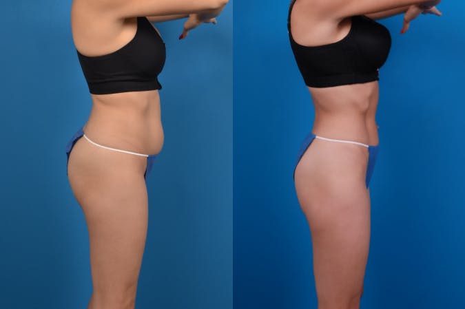 CoolSculpting Before & After Gallery - Patient 122405640 - Image 5