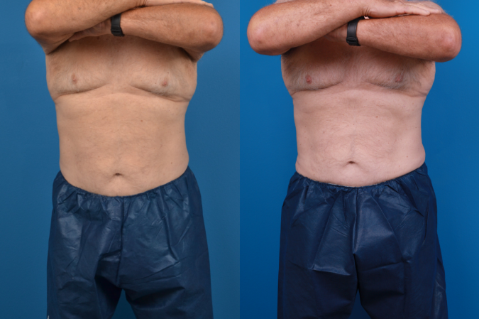 CoolSculpting Before & After Gallery - Patient 102982 - Image 1