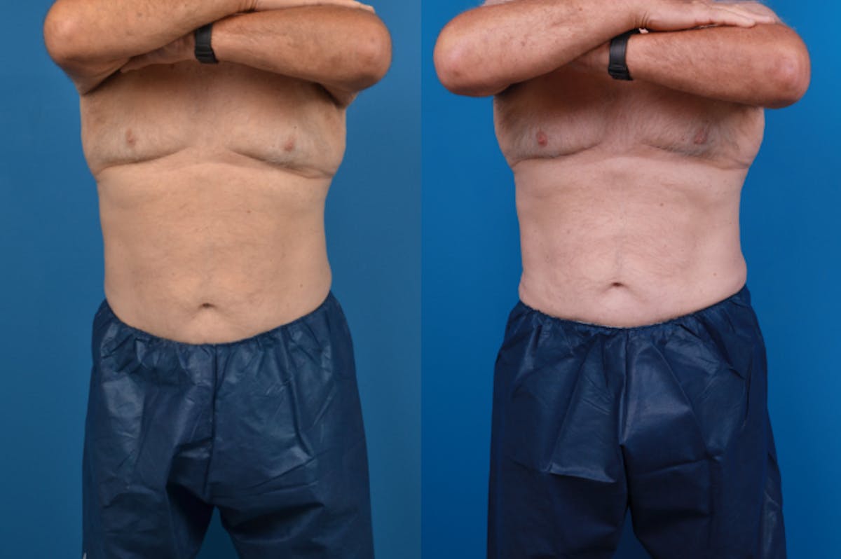 CoolSculpting Before & After Gallery - Patient 122405642 - Image 1