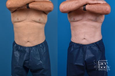 CoolSculpting Before & After Gallery - Patient 102982 - Image 1