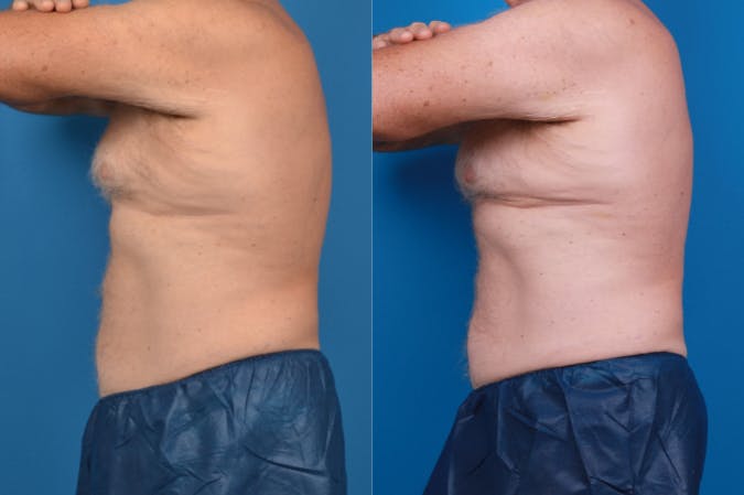 CoolSculpting Before & After Gallery - Patient 122405642 - Image 2