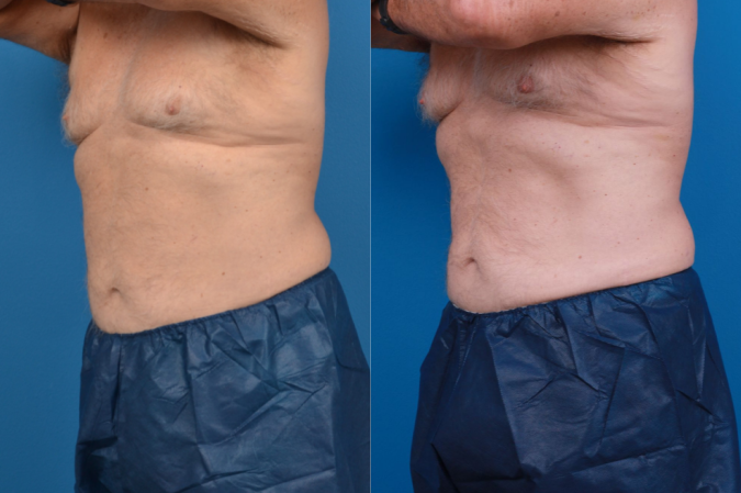 CoolSculpting Before & After Gallery - Patient 102982 - Image 3