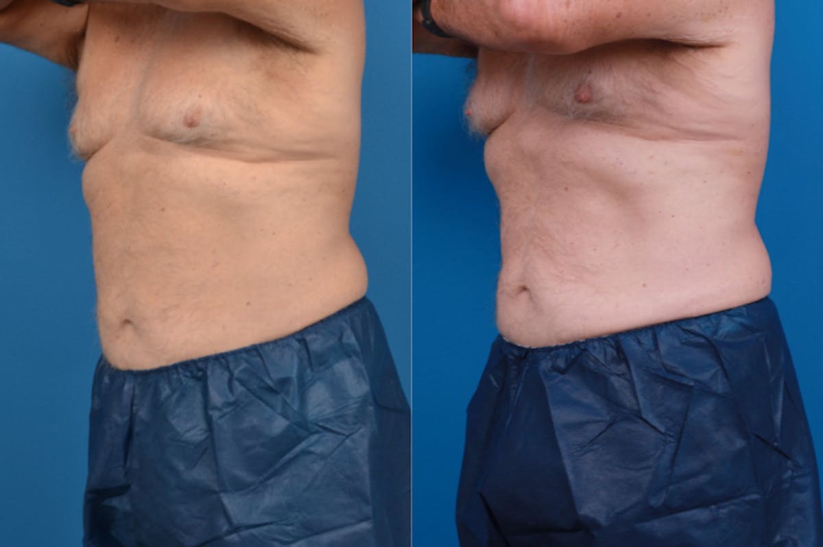 CoolSculpting Before & After Gallery - Patient 122405642 - Image 3