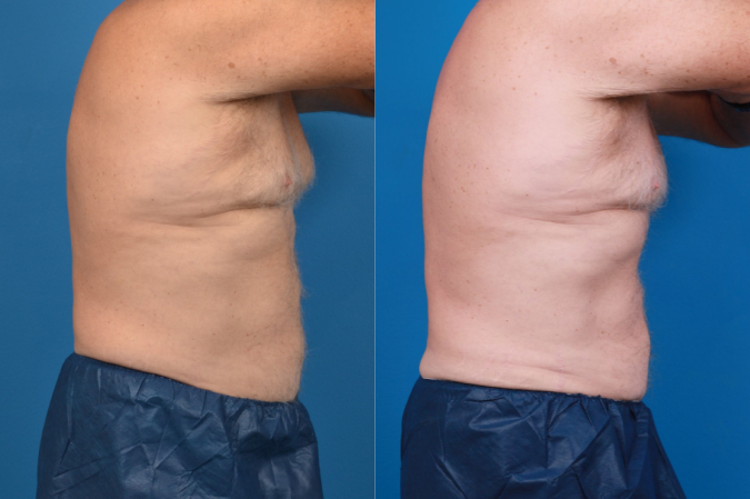 CoolSculpting Before & After Gallery - Patient 102982 - Image 4