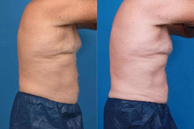 CoolSculpting Before & After Gallery - Patient 122405642 - Image 4