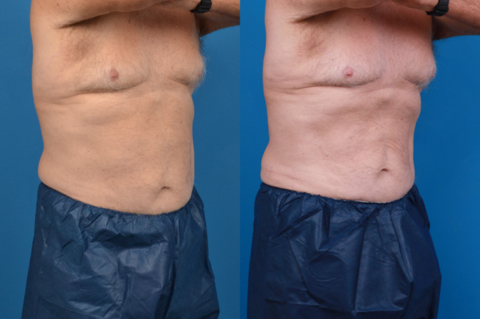 CoolSculpting Before & After Gallery - Patient 102982 - Image 5