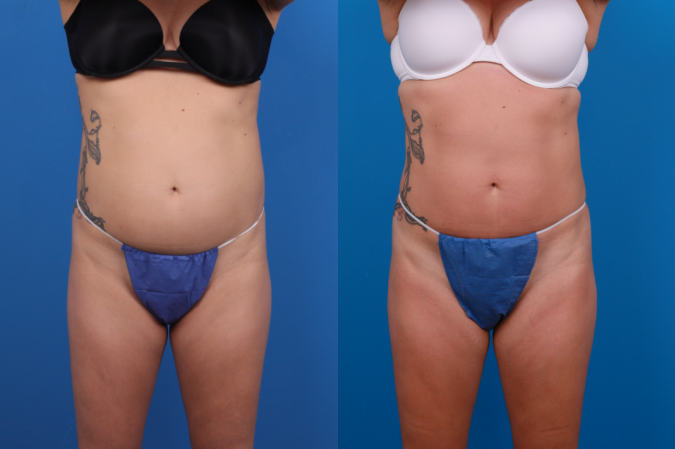 CoolSculpting Before & After Gallery - Patient 209553 - Image 1