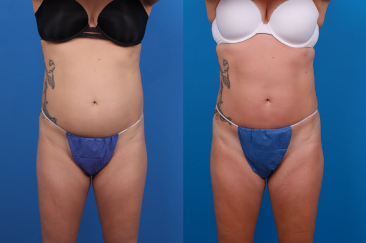 CoolSculpting Before & After Gallery - Patient 122405643 - Image 1