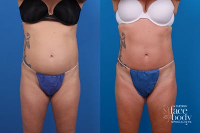 CoolSculpting Before & After Gallery - Patient 209553 - Image 1