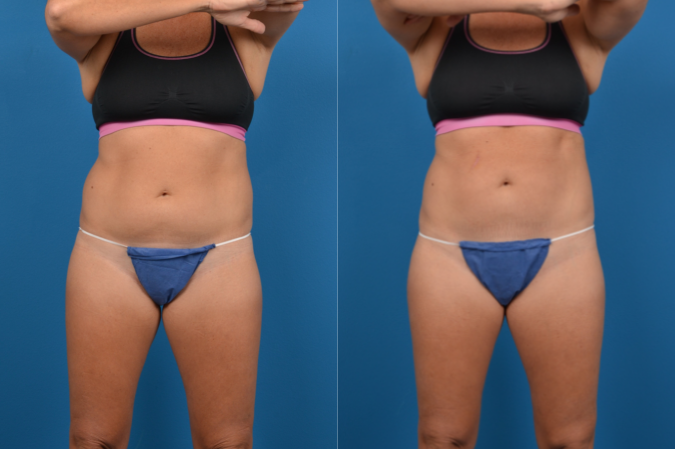 CoolSculpting Before & After Gallery - Patient 153660 - Image 1