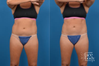 CoolSculpting Before & After Gallery - Patient 153660 - Image 1