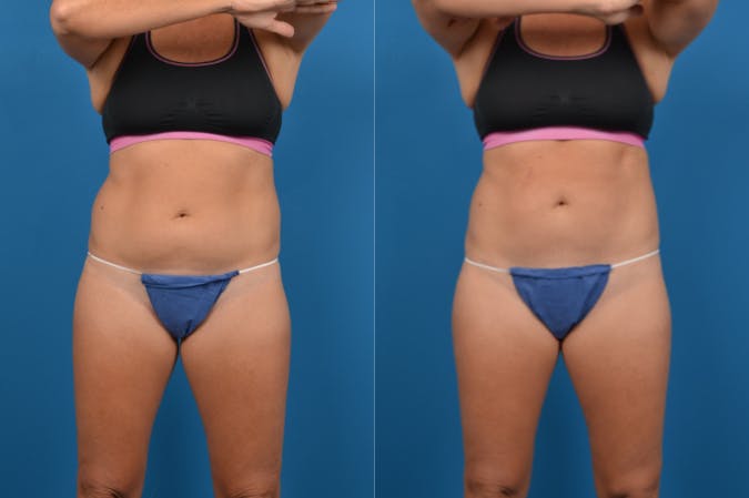 CoolSculpting Before & After Gallery - Patient 122405644 - Image 1