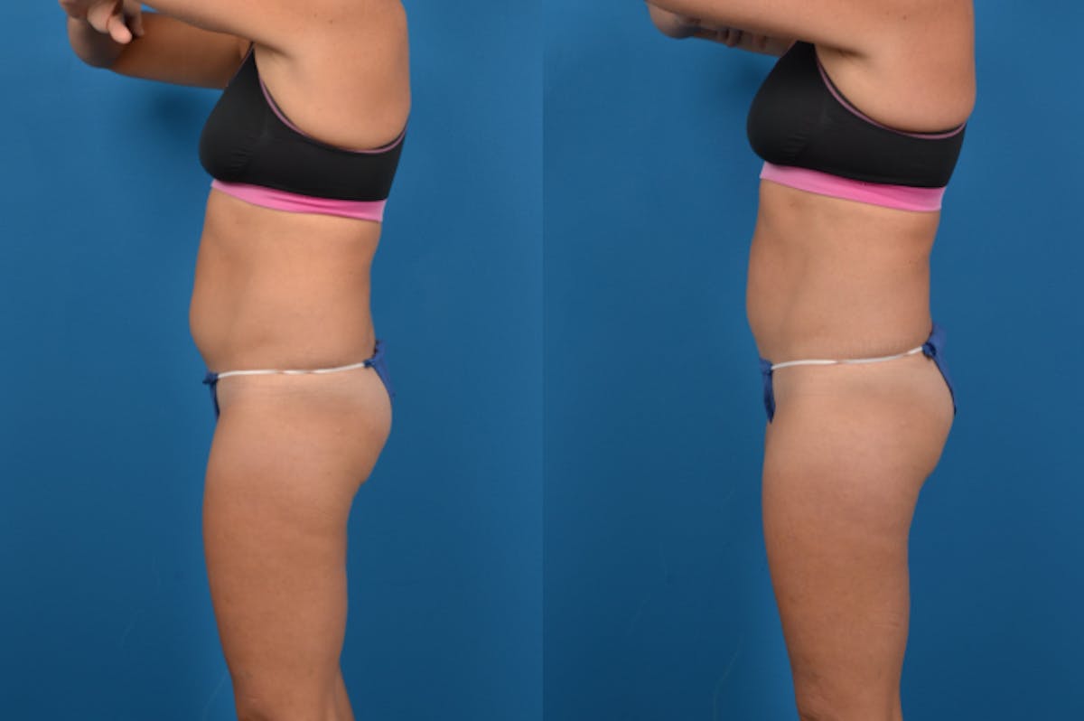 CoolSculpting Before & After Gallery - Patient 122405644 - Image 2