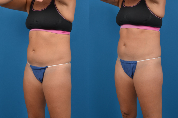 CoolSculpting Before & After Gallery - Patient 153660 - Image 3