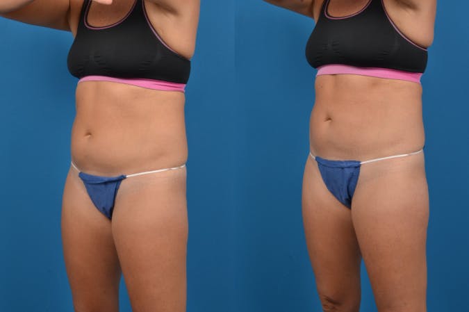 CoolSculpting Gallery - Patient 122405644 - Image 3