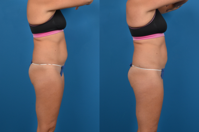 CoolSculpting Before & After Gallery - Patient 153660 - Image 4