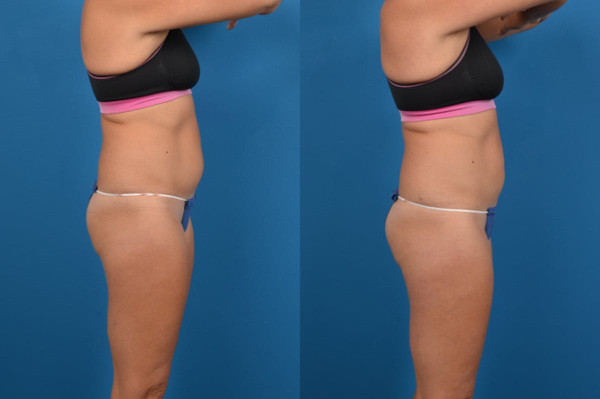 CoolSculpting Before & After Gallery - Patient 122405644 - Image 4