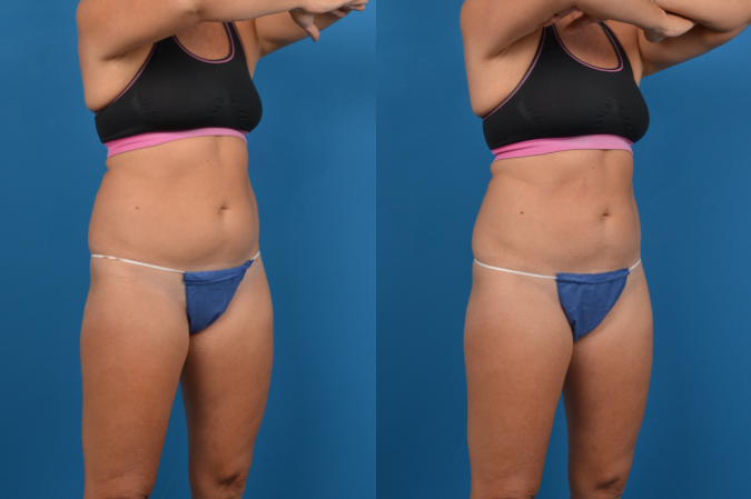 CoolSculpting Before & After Gallery - Patient 153660 - Image 5