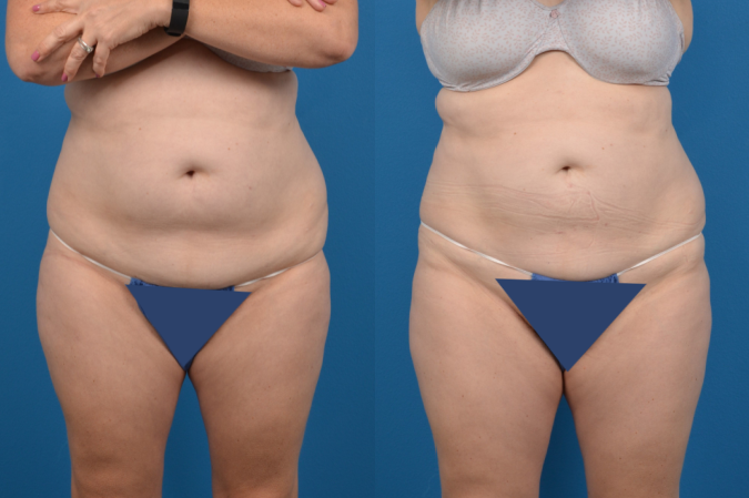 CoolSculpting Before & After Gallery - Patient 317635 - Image 1