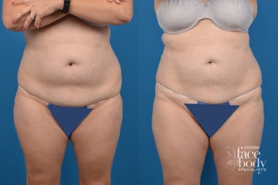 CoolSculpting Before & After Gallery - Patient 317635 - Image 1