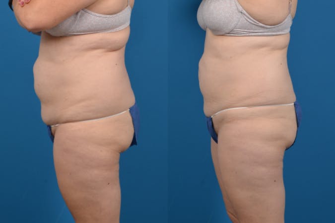 CoolSculpting Before & After Gallery - Patient 122405647 - Image 2