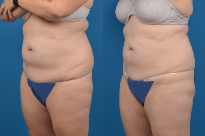 CoolSculpting Before & After Gallery - Patient 317635 - Image 3