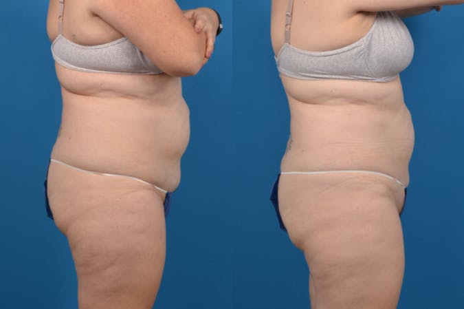 CoolSculpting Before & After Gallery - Patient 122405647 - Image 4
