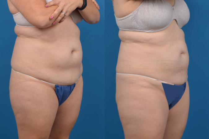CoolSculpting Before & After Gallery - Patient 317635 - Image 5