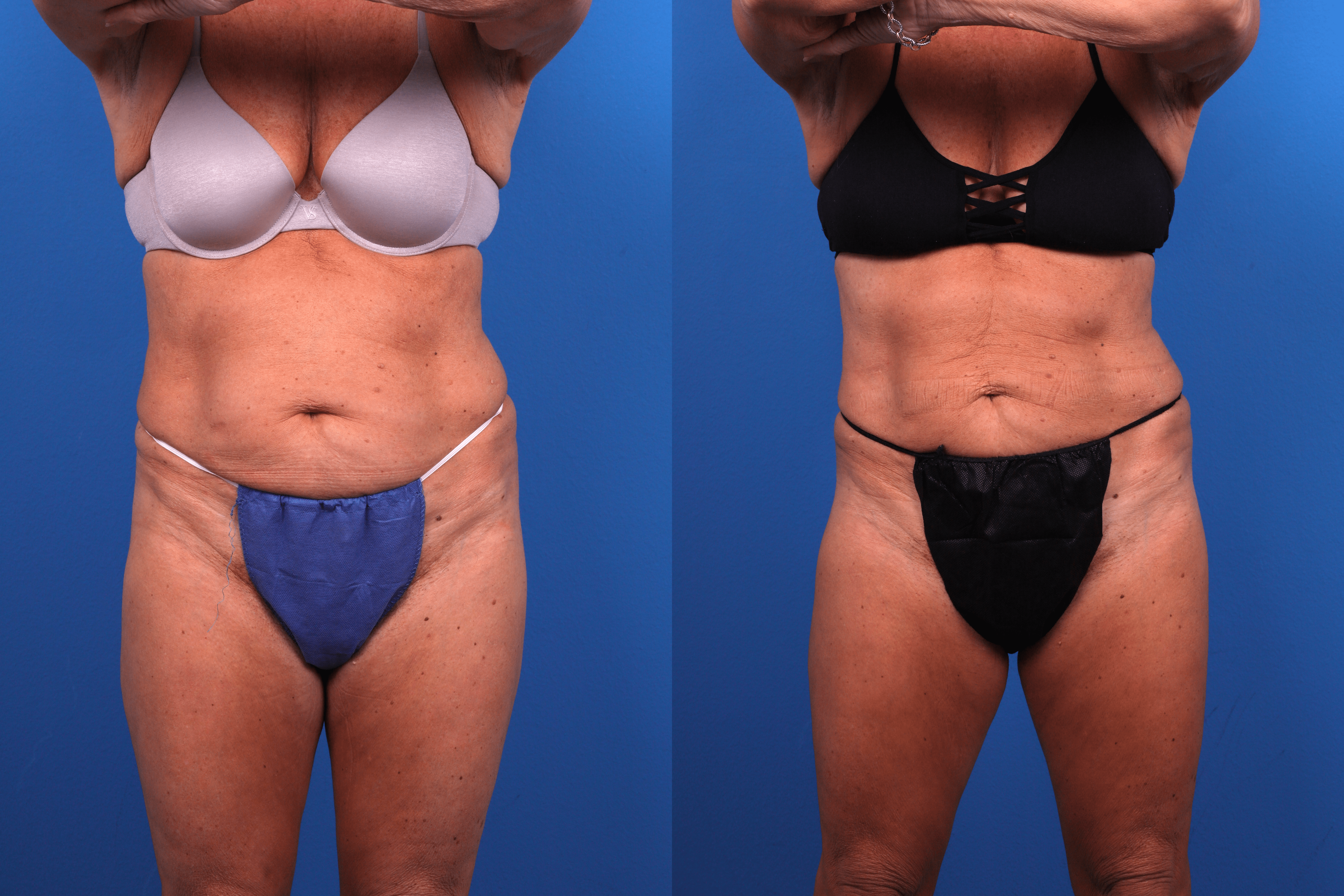 CoolSculpting Before & After Gallery - Patient 424158 - Image 1