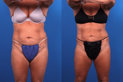 CoolSculpting Before & After Gallery - Patient 122405649 - Image 1