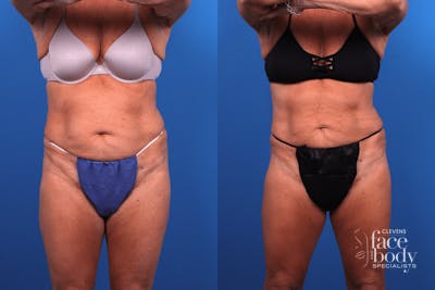 CoolSculpting Before & After Gallery - Patient 424158 - Image 1