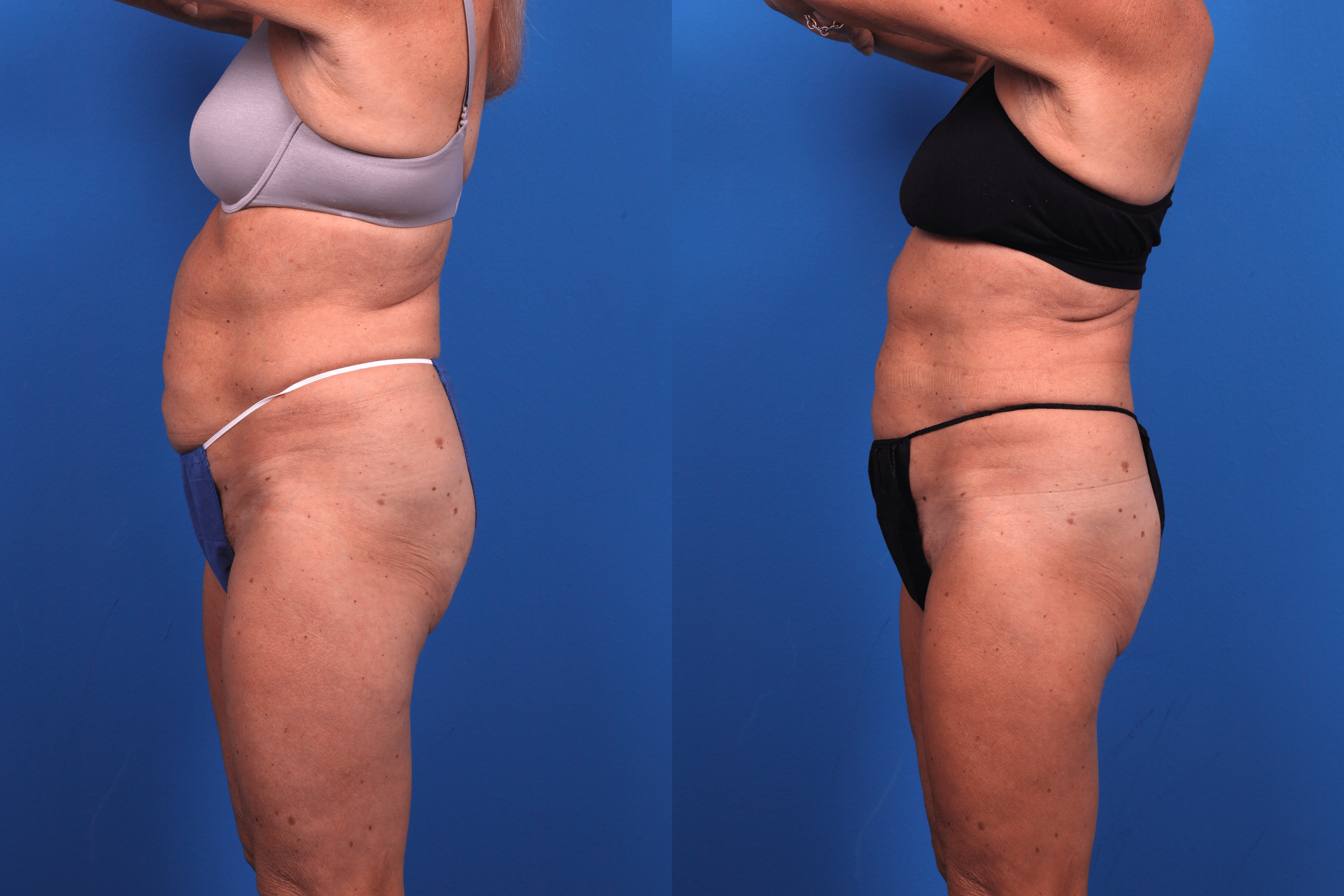 CoolSculpting Before & After Gallery - Patient 424158 - Image 2