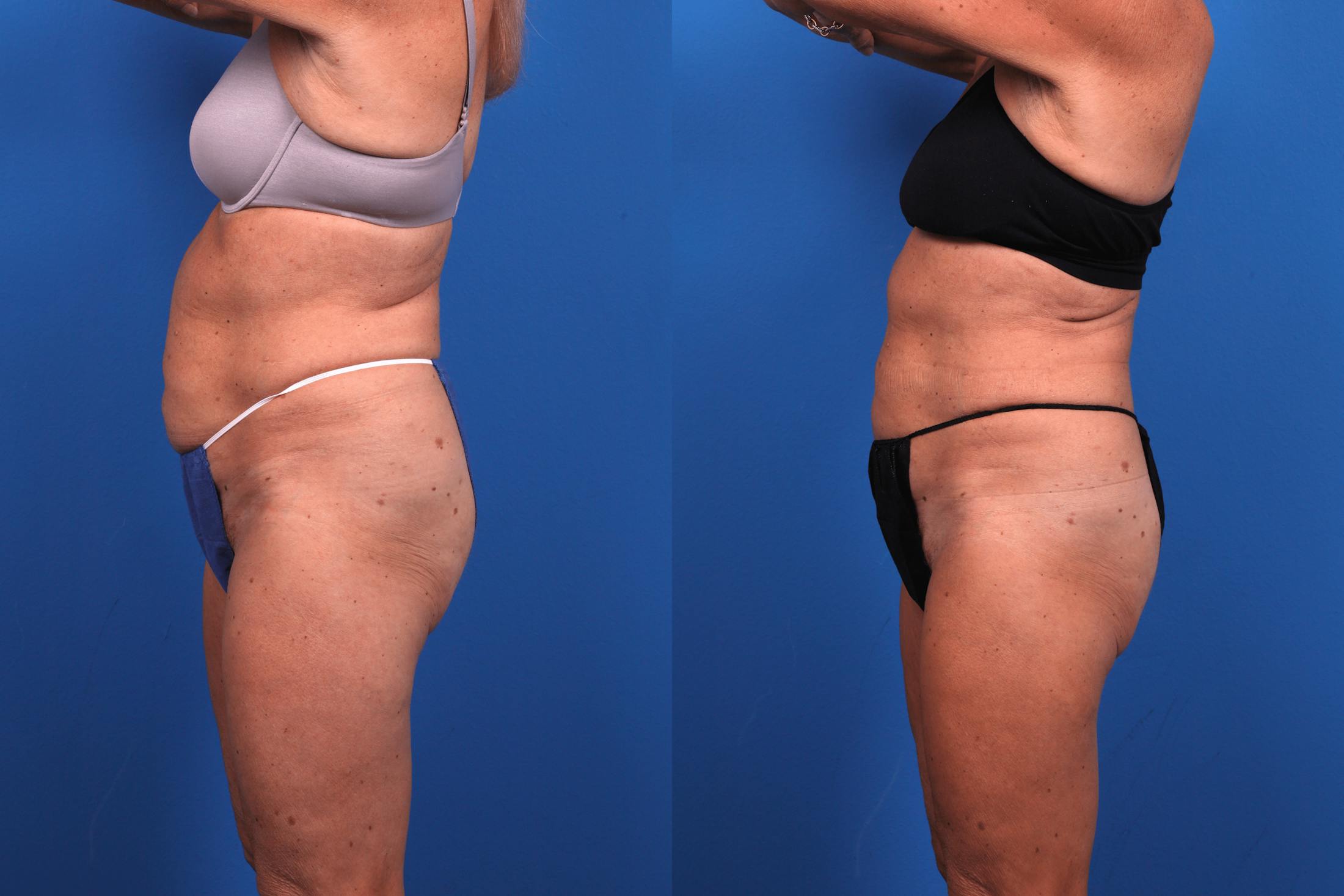 CoolSculpting Before & After Gallery - Patient 122405649 - Image 2