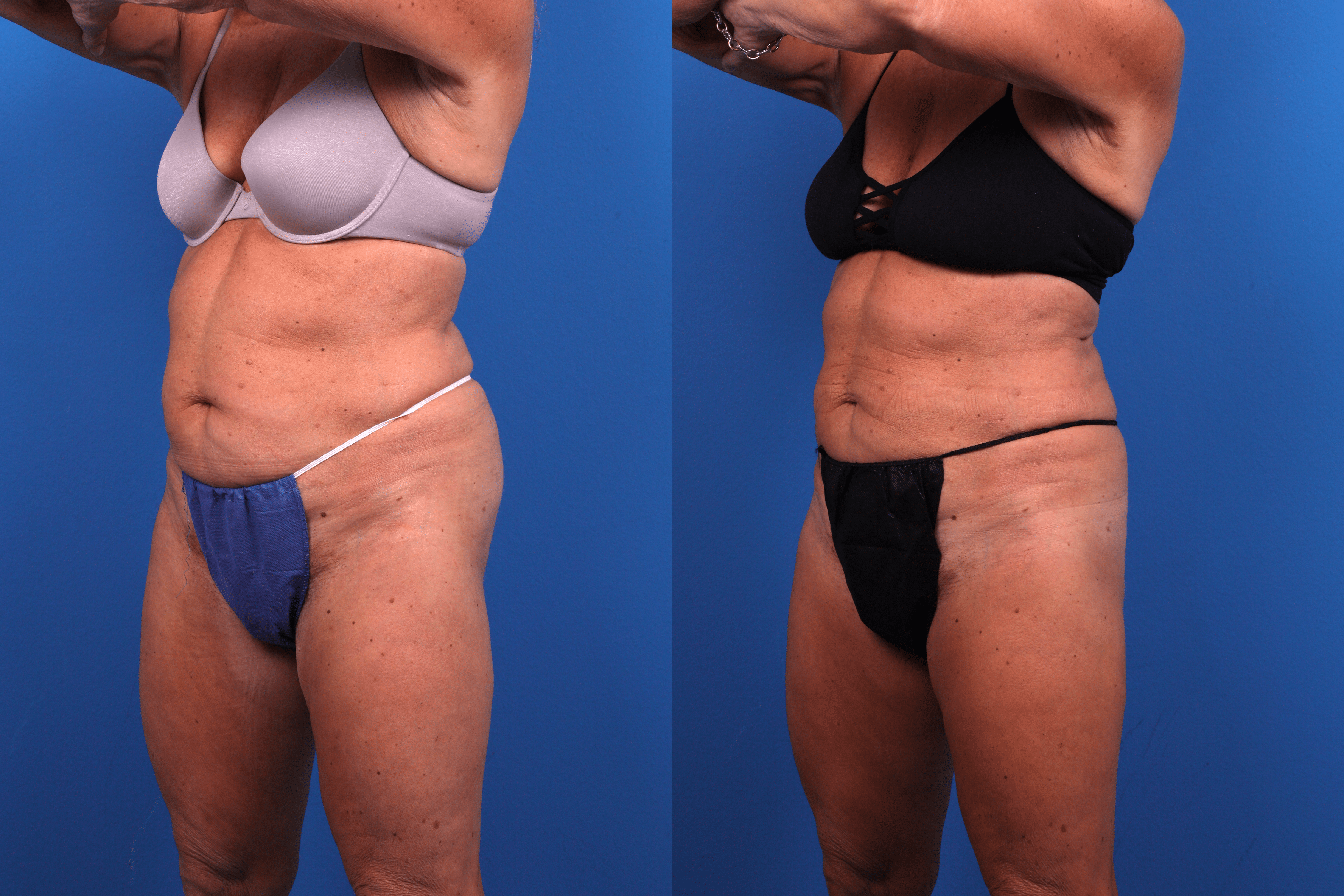 CoolSculpting Before & After Gallery - Patient 424158 - Image 3