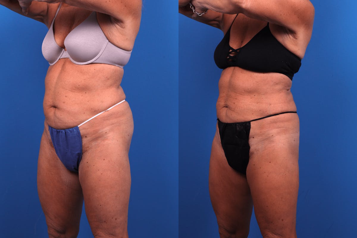 CoolSculpting Before & After Gallery - Patient 122405649 - Image 3