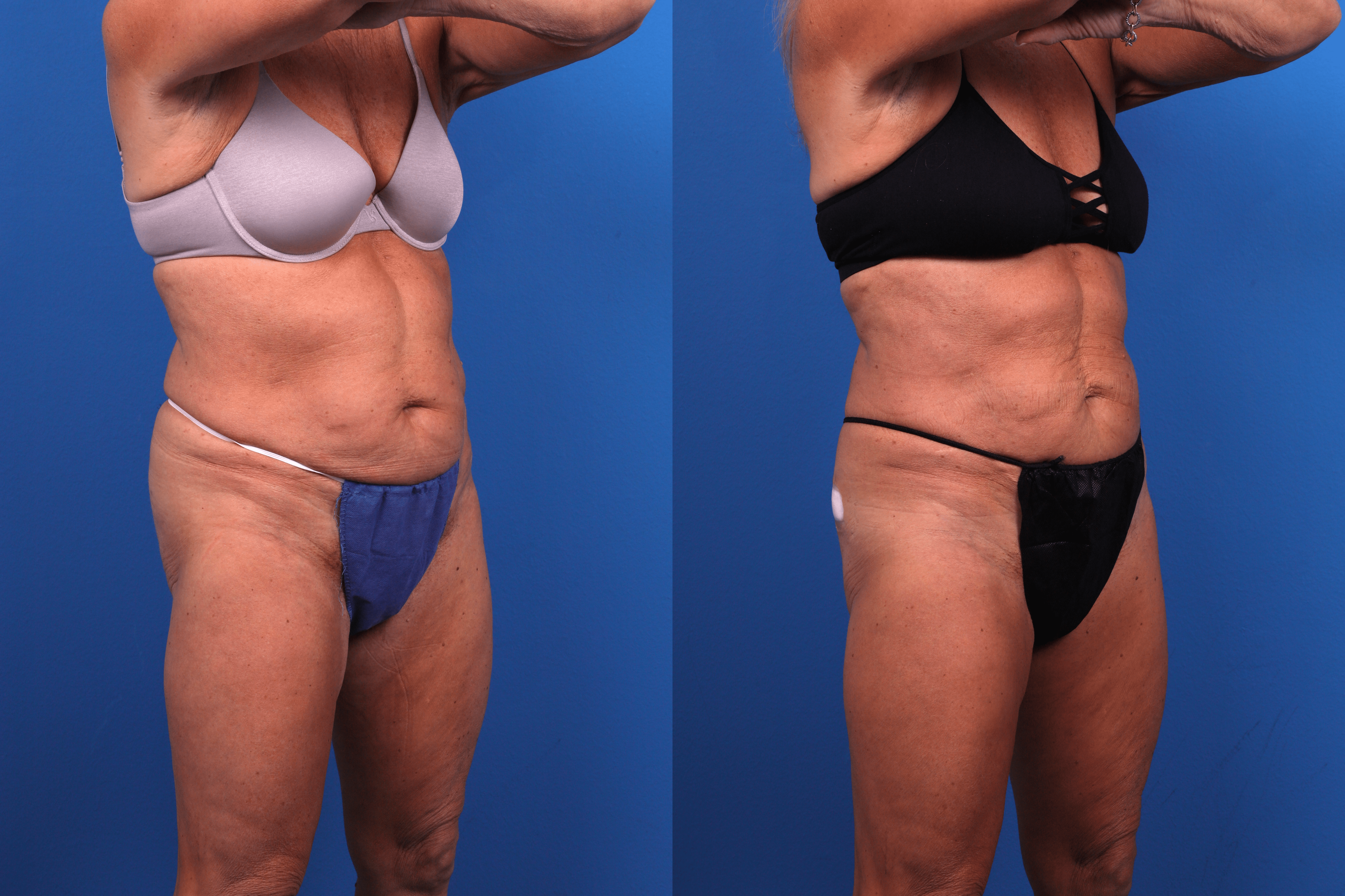 CoolSculpting Before & After Gallery - Patient 424158 - Image 4