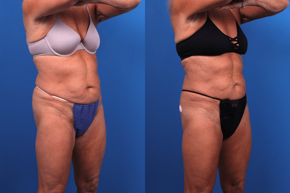 CoolSculpting Before & After Gallery - Patient 122405649 - Image 4